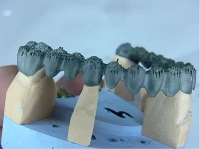 Зубной мост на модели челюсти - стоматологическая 3D-печать металлом
