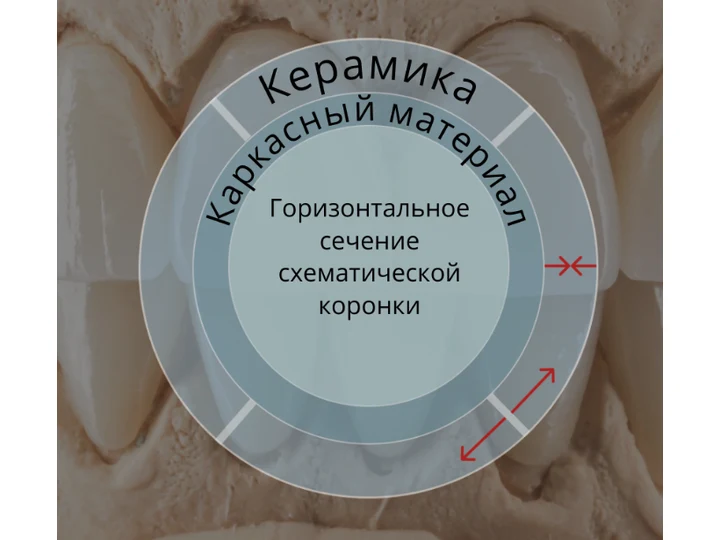 Схема сечения коронки: керамика и каркасный материал, направление напряжений